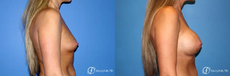 Denver Breast Augmentation 3626 - Before and After 4