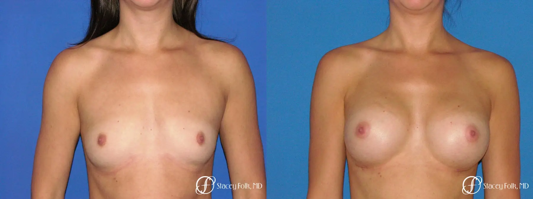 Denver Breast Augmentation 4779 - Before and After