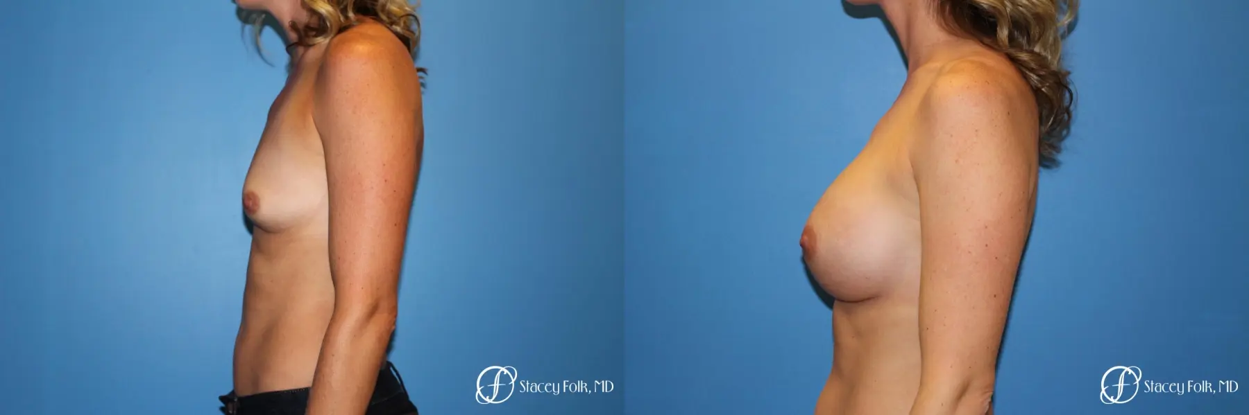 Denver Breast augmentation 4740 - Before and After 5