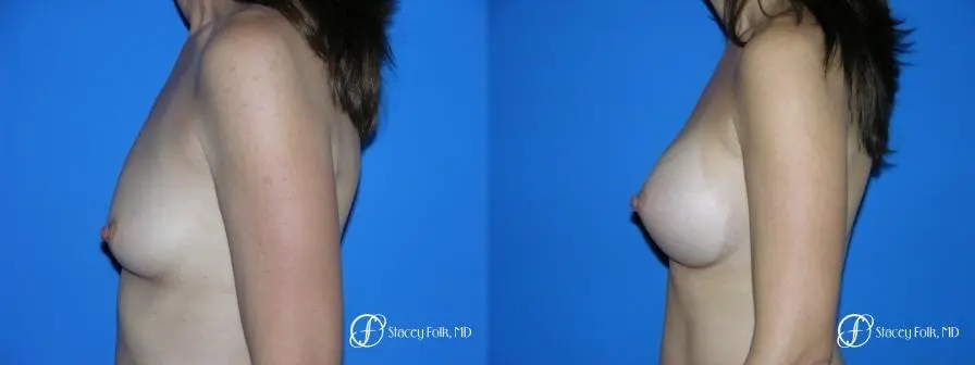 Denver Breast Augmentation 10 - Before and After 3