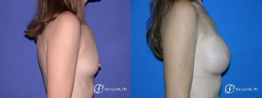 Denver Breast Augmentation 7 - Before and After 3