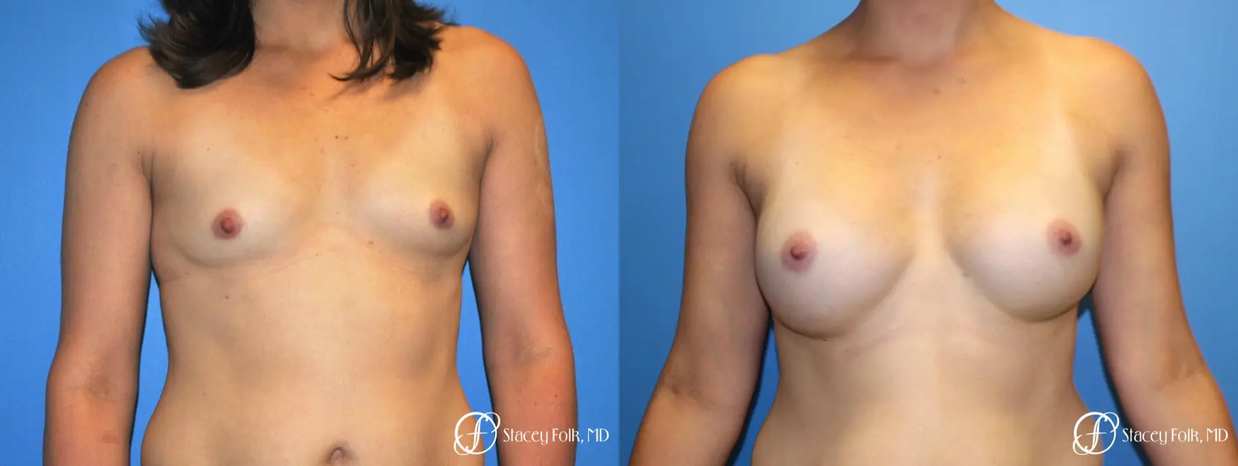 Denver Breast augmentation 7111 - Before and After 1