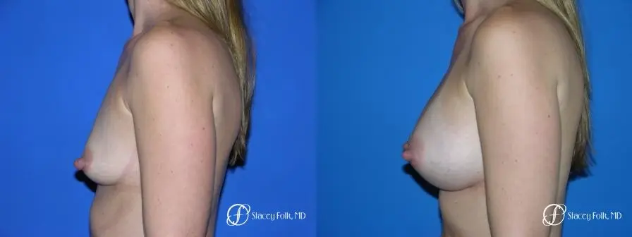 Denver Breast Augmentation 26 - Before and After 3