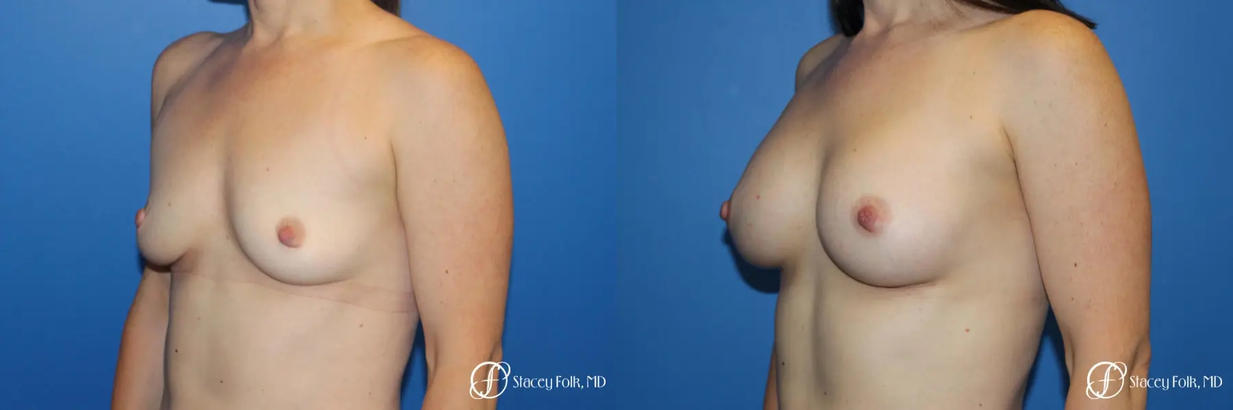 Breast augmentation with Natrelle Inspira breast implants - Before and After 4