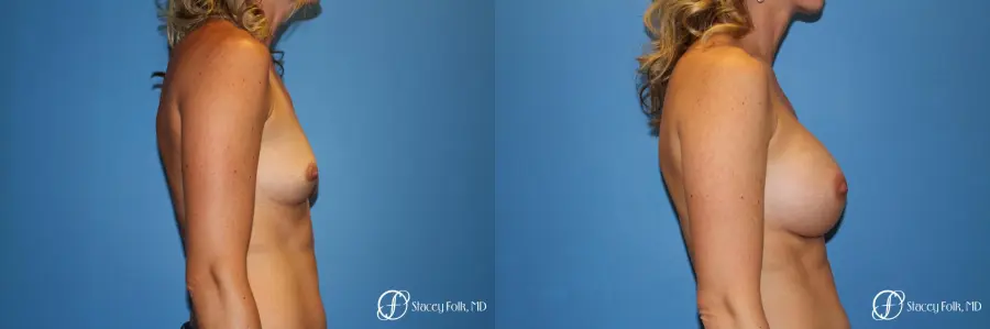 Denver Breast augmentation 4740 - Before and After 4