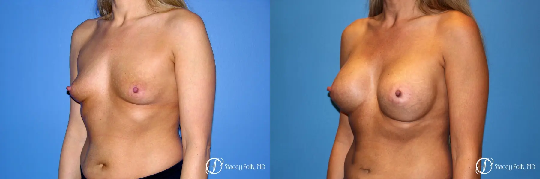 Denver Breast Augmentation 3626 - Before and After 2