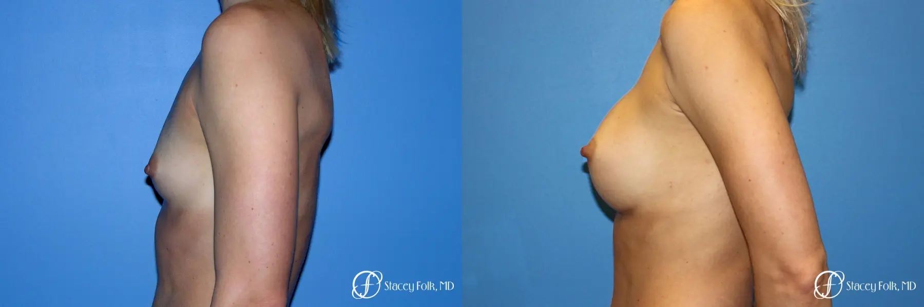 Denver Breast Augmentation 8202 - Before and After 3