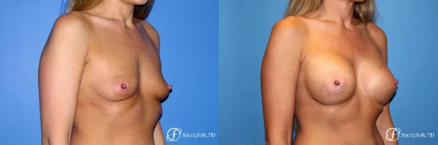 Denver Breast Augmentation 3626 - Before and After 3