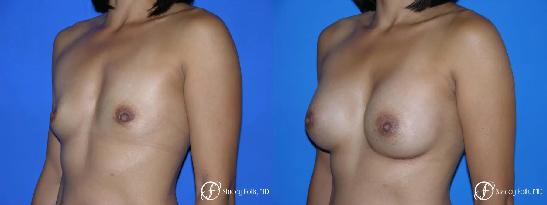 Denver Breast Augmentation 3629 - Before and After 2