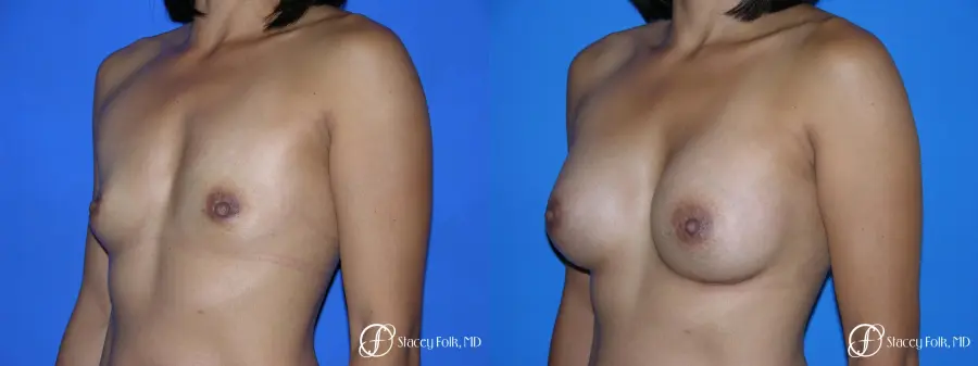 Denver Breast Augmentation 3629 - Before and After 2