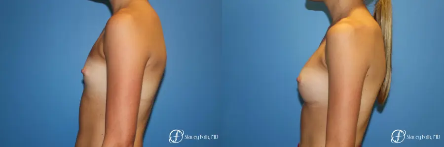Denver Breast Augmentation with Sientra Breast Implants 9094 - Before and After 3