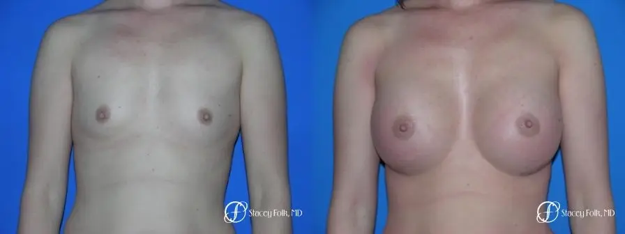 Denver Breast Augmentation 33 - Before and After 1