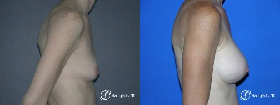 Denver Breast Augmentation 12 - Before and After 3