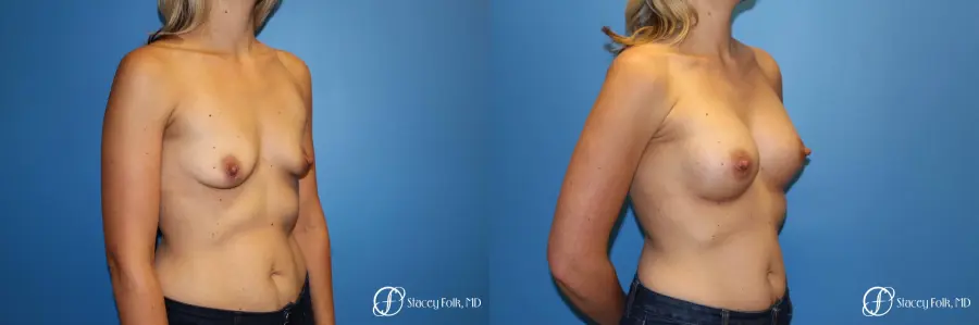 Denver Breast Augmentation 4816 - Before and After 3