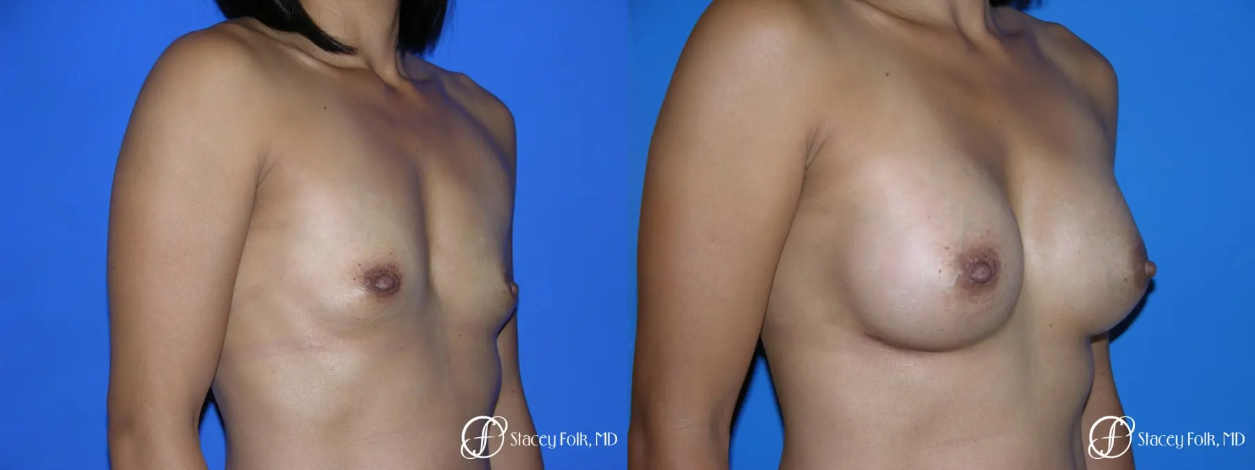 Denver Breast Augmentation 3629 - Before and After 3