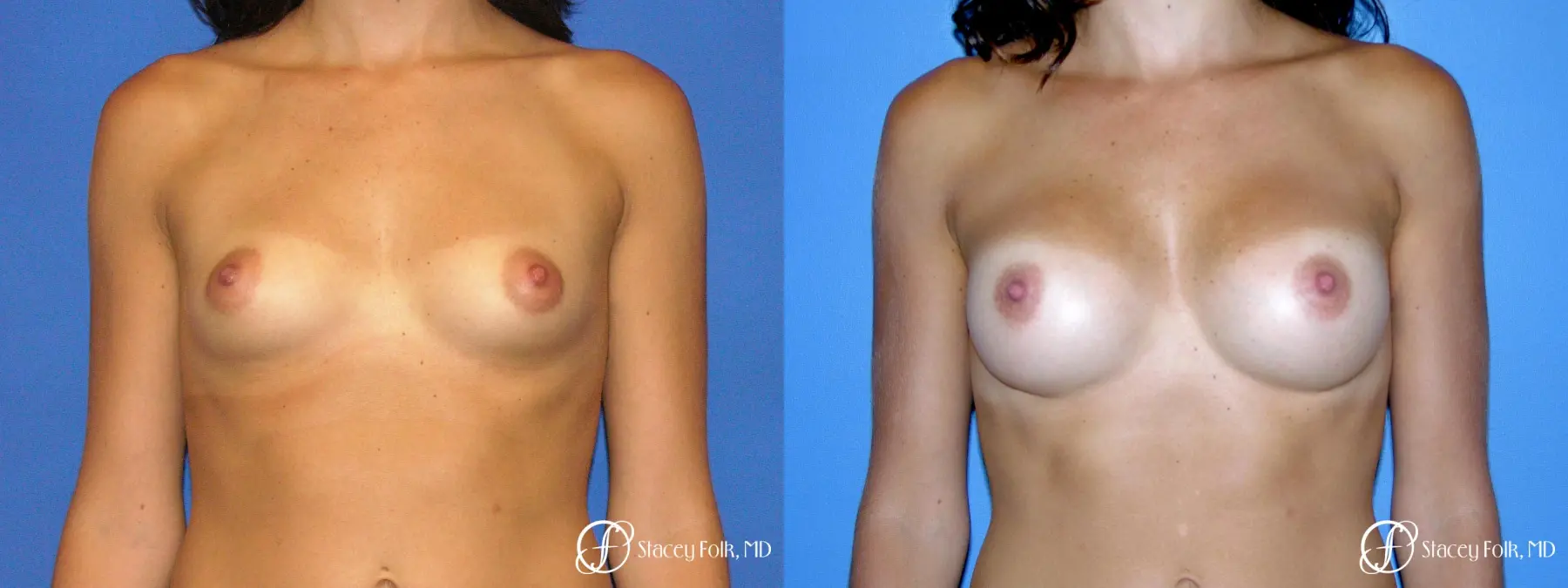 Denver Breast Augmentation 9136 - Before and After 1