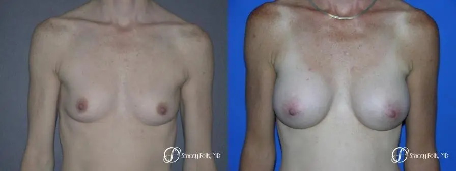 Denver Breast Augmentation 12 - Before and After