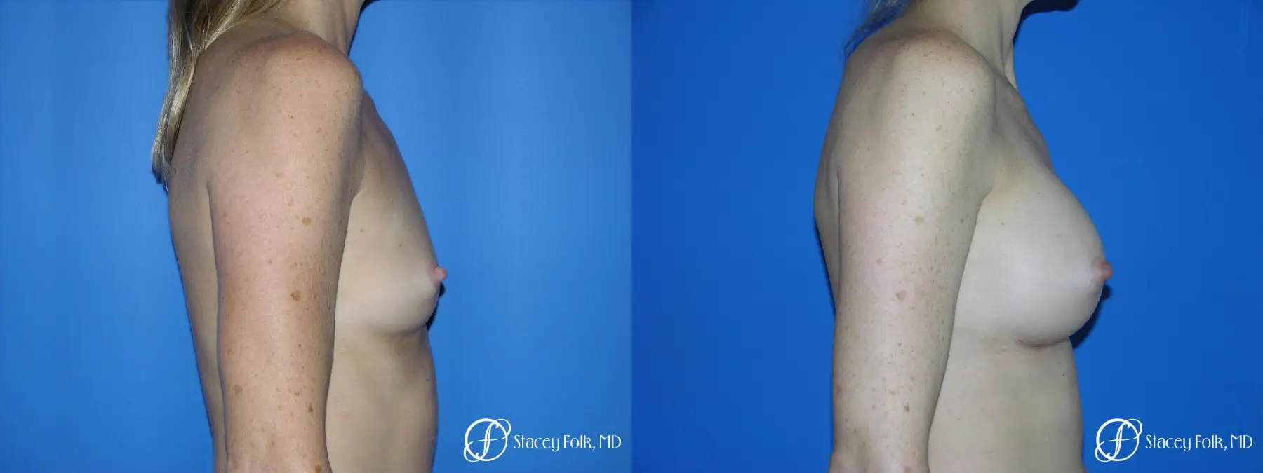 Denver Breast Augmentation 3633 - Before and After 3