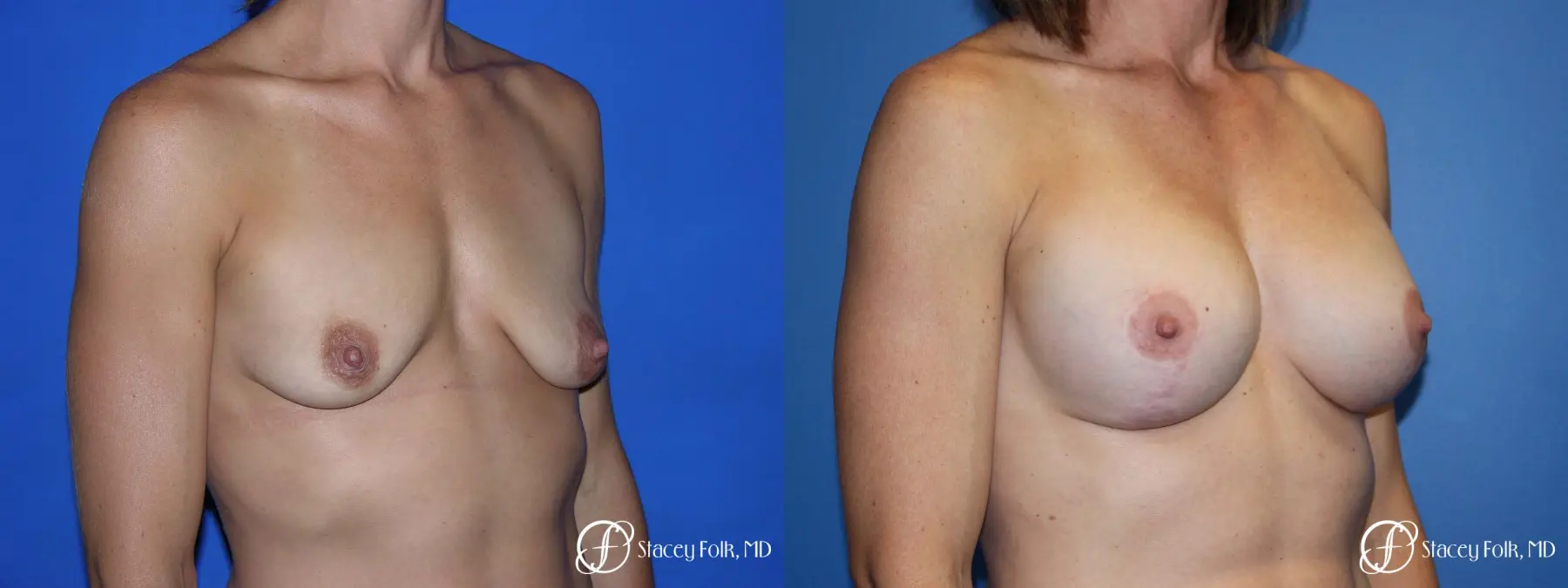 Denver Breast augmentation and breast lift (Mastopexy) 10091 - Before and After 2