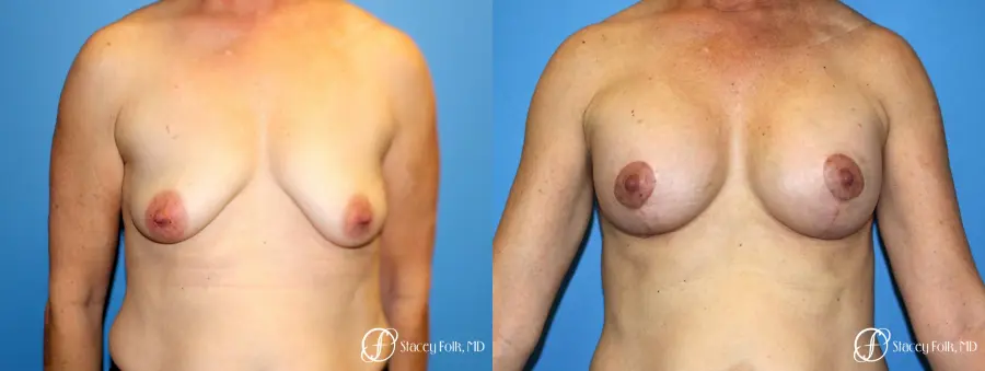 Denver Breast Augmentation Mastopexy 8163 - Before and After 1