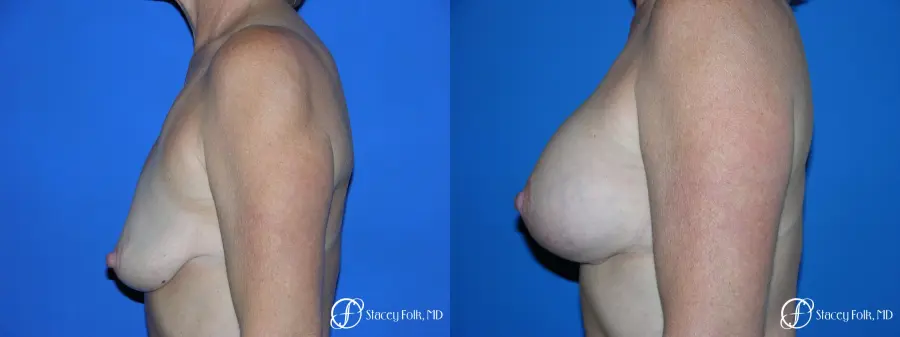 Denver Breast Lift and Augmentation 4557 - Before and After 3