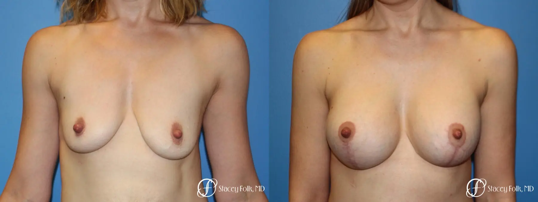 Denver Breast lift and Augmentation 7850 - Before and After
