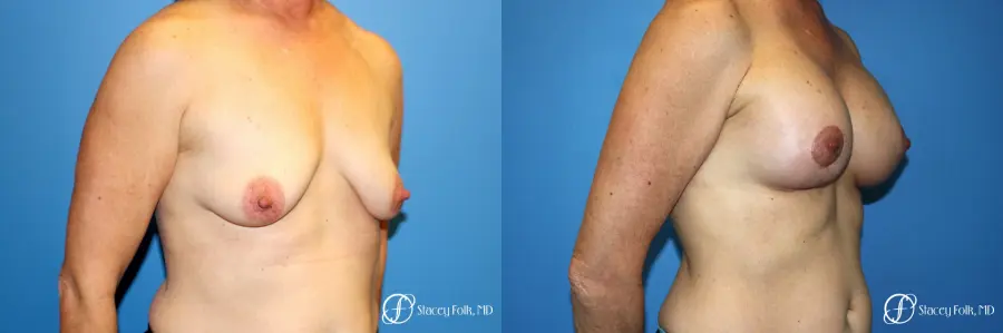 Denver Breast Augmentation Mastopexy 8163 - Before and After 3