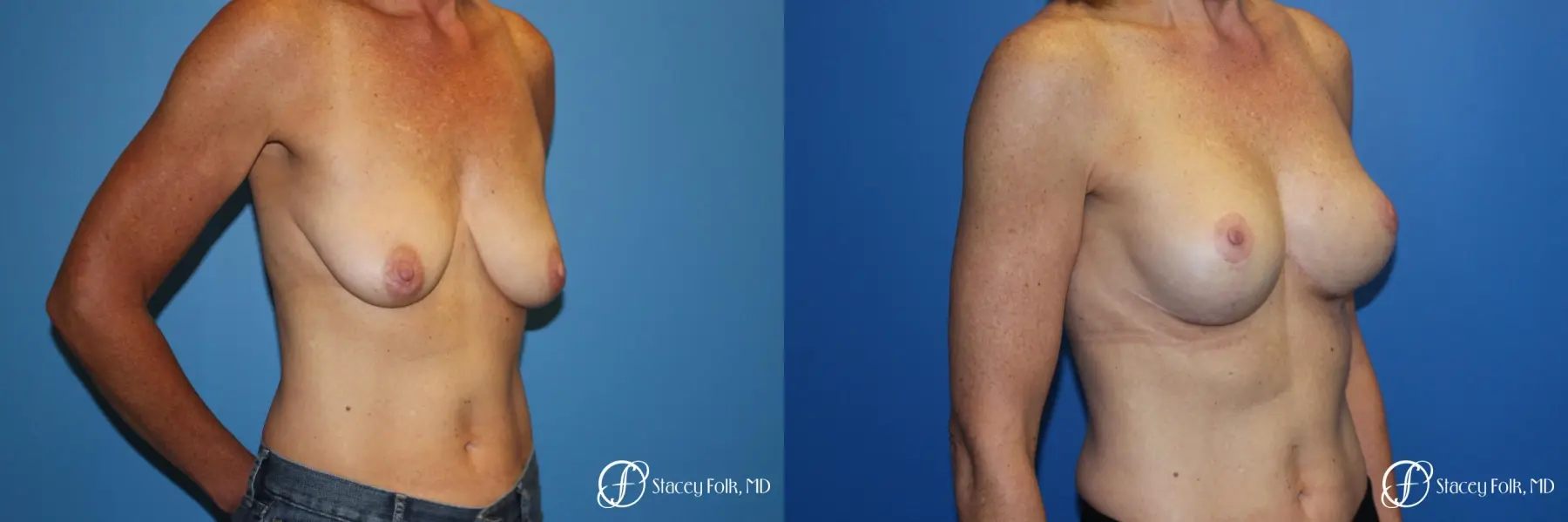Breast Augmentation with Breast Lift (Augmentation/Mastopexy) - Before and After 2