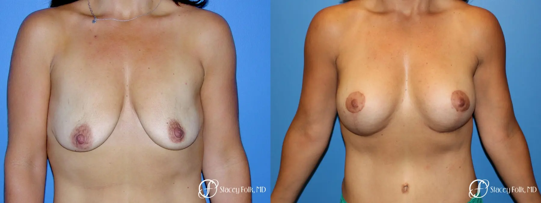 Denver Breast Augmentation Mastopexy 5366 - Before and After 1