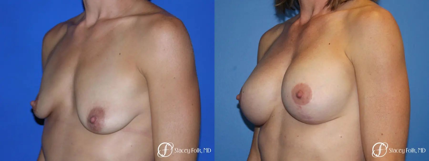 Denver Breast augmentation and breast lift (Mastopexy) 10091 - Before and After 3