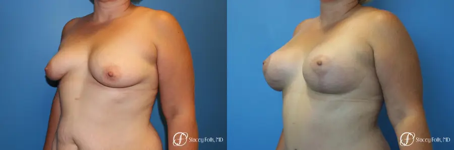 Denver Breast Augmentation Mastopexy 8507 - Before and After 2