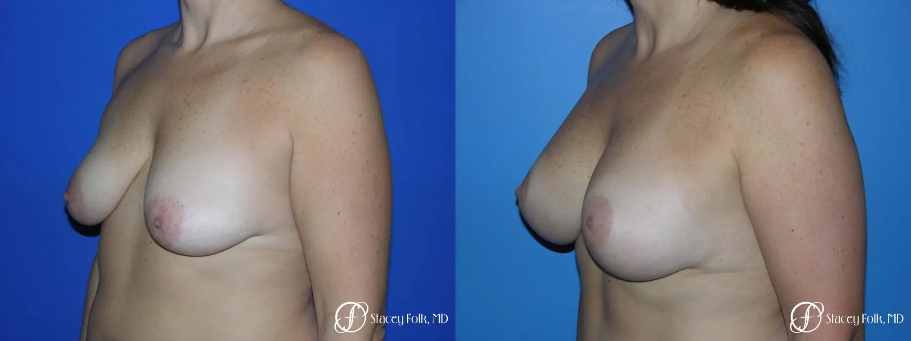Denver Breast Lift - Mastopexy Augmentation 7989 - Before and After 2