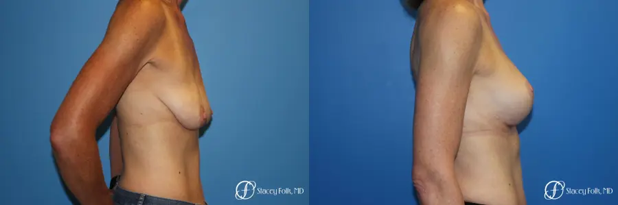 Breast Augmentation with Breast Lift (Augmentation/Mastopexy) - Before and After 3