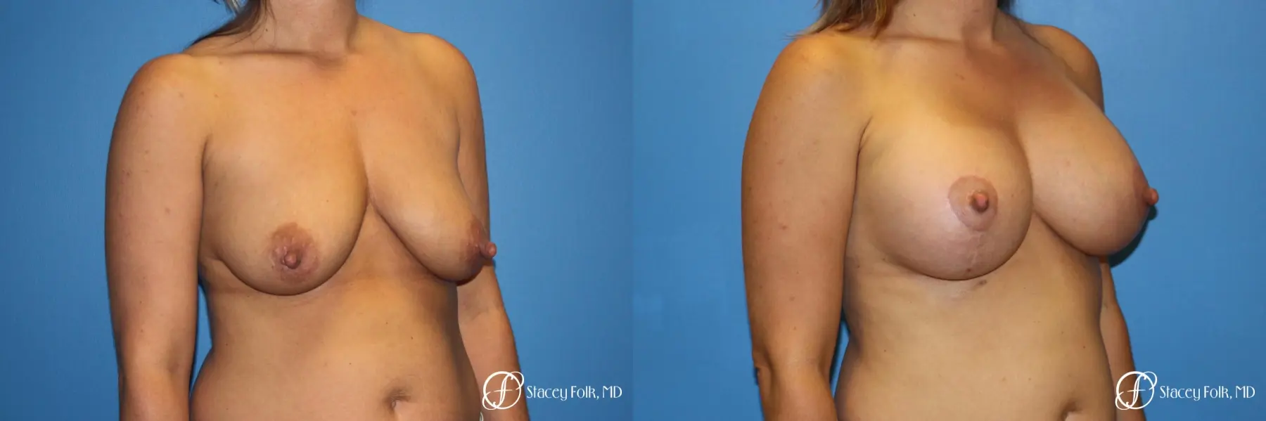Denver Breast Lift and Augmentation 8629 - Before and After 2