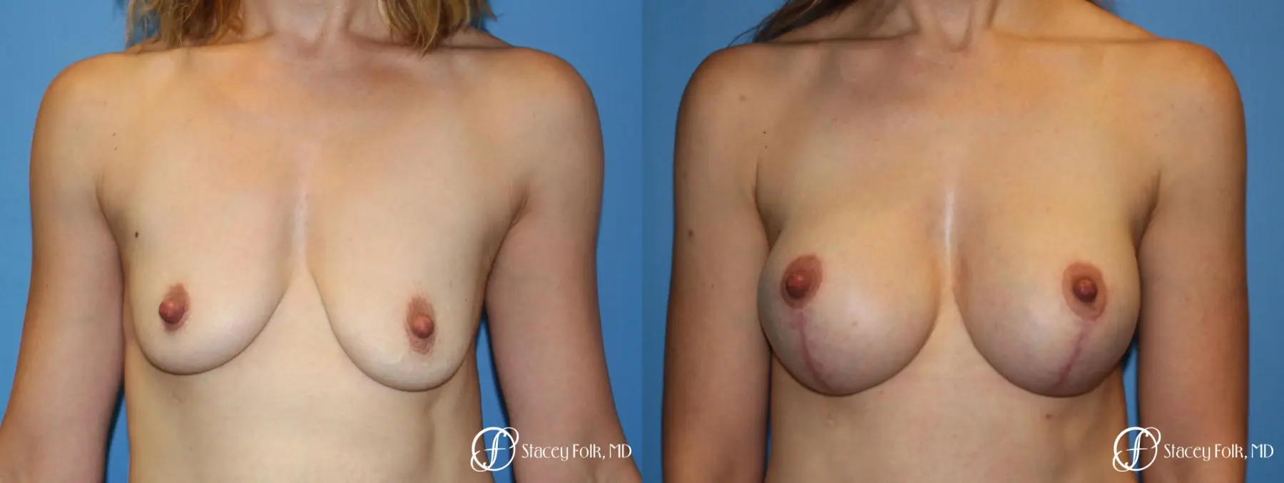 Breast Augmentation and Breast lift (Mastopexy) - Before and After 1