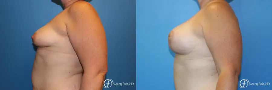 Denver Breast Augmentation Mastopexy 8507 - Before and After 4