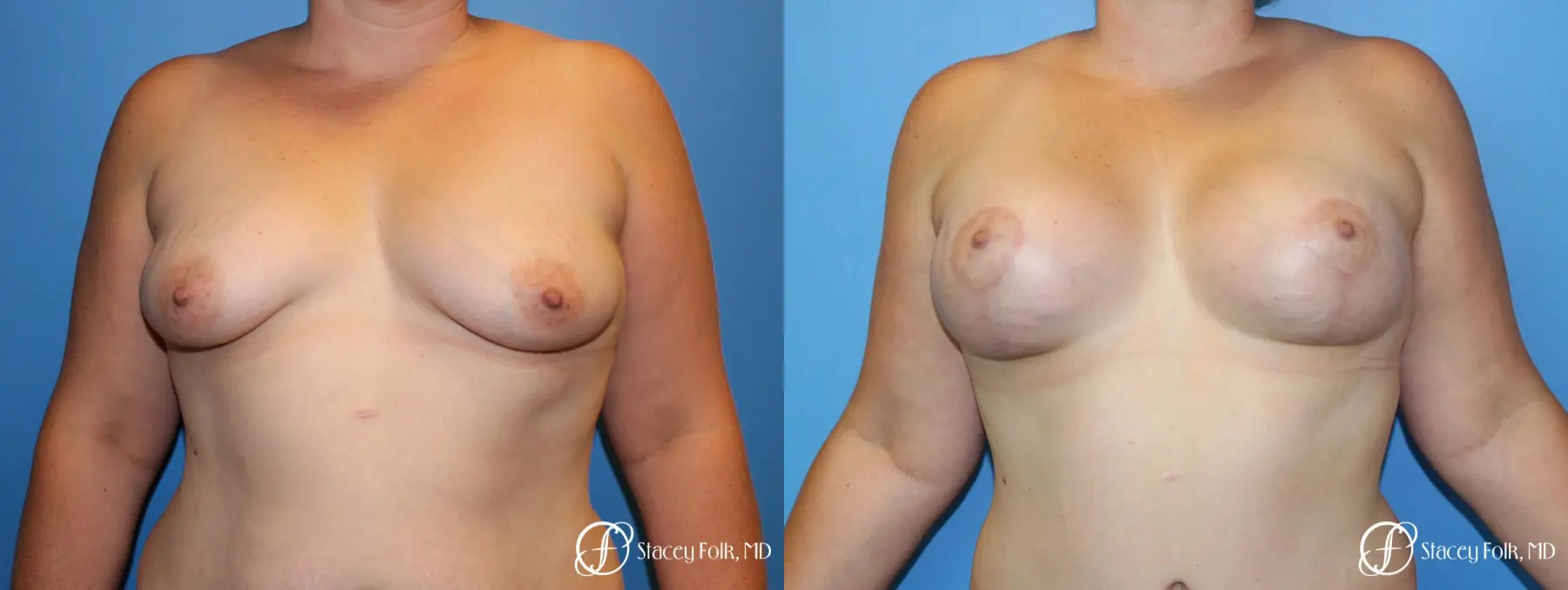 Denver Breast Augmentation Mastopexy 8507 - Before and After