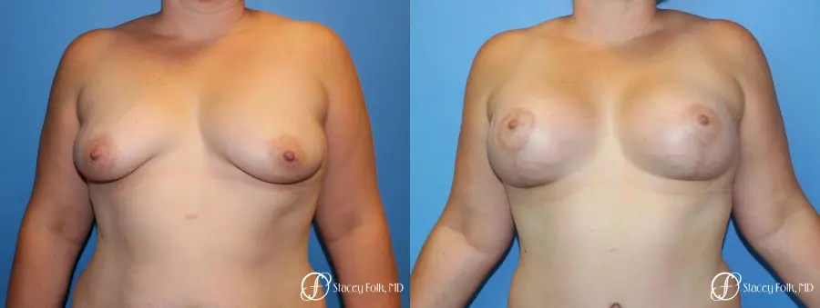 Denver Breast Augmentation Mastopexy 8507 - Before and After 1