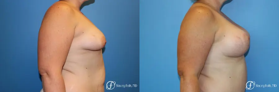 Denver Breast Augmentation Mastopexy 8507 - Before and After 5