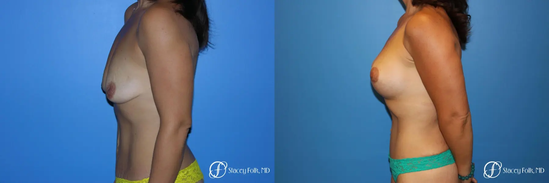 Denver Breast Augmentation Mastopexy 5366 - Before and After 3