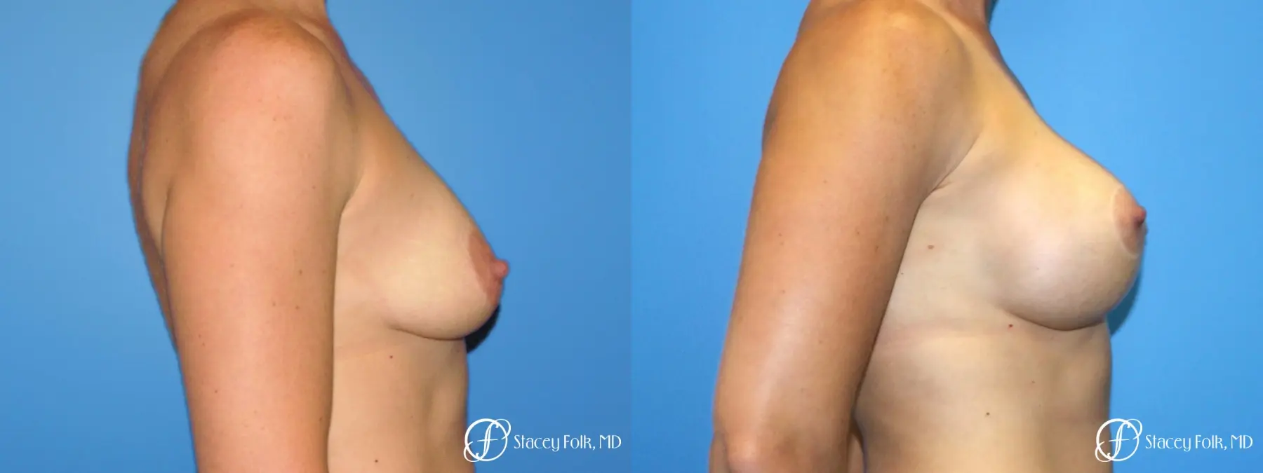 Denver Breast Augmentation with a Breast Lift - Mastopexy 8361 - Before and After 3