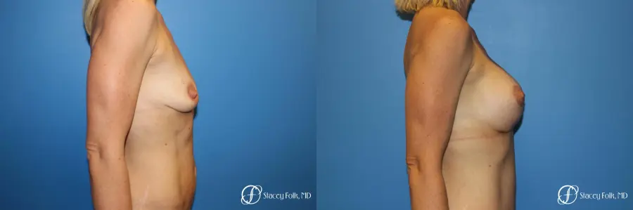 Breast augmentation with breast lift (Mastopexy) - Before and After 3