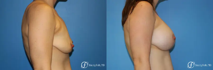 Denver Breast Lift (Mastopexy) with agumentation 9093 - Before and After 3