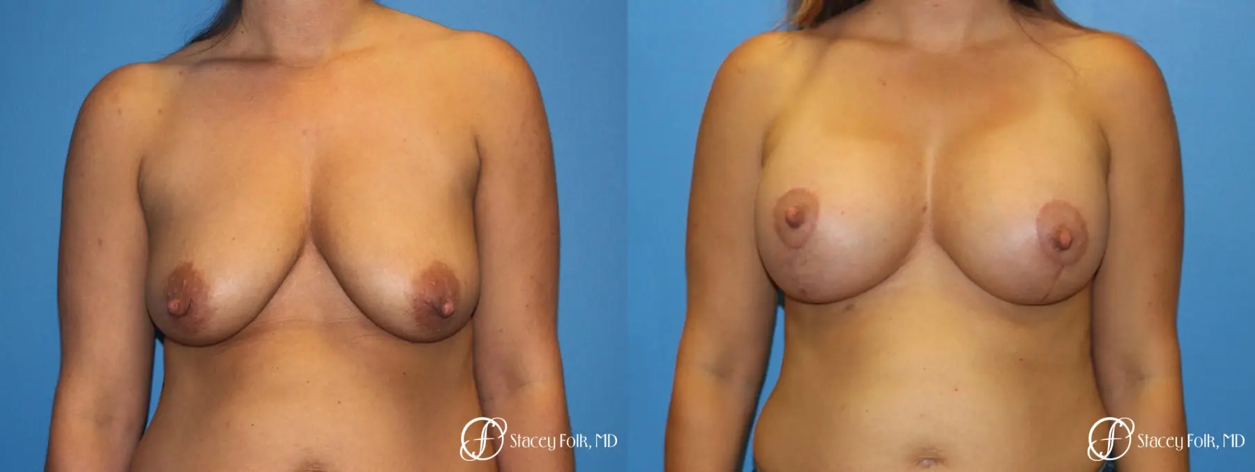 Denver Breast Lift and Augmentation 8629 - Before and After 1