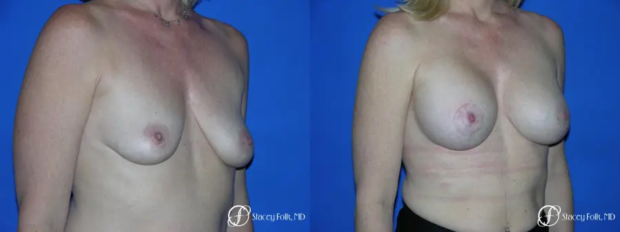 Denver Breast Lift and Augmentation 4555 - Before and After 2