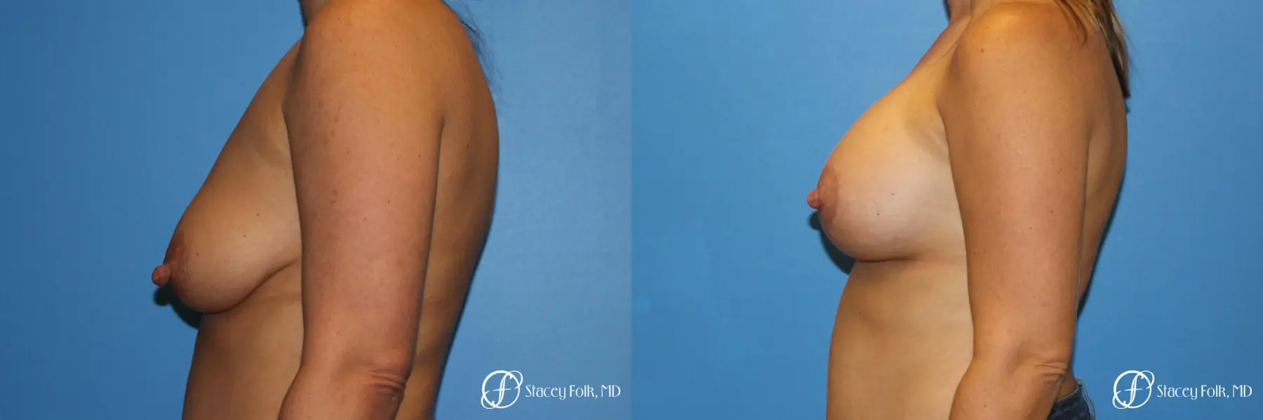 Denver Breast Lift and Augmentation 8629 - Before and After 3