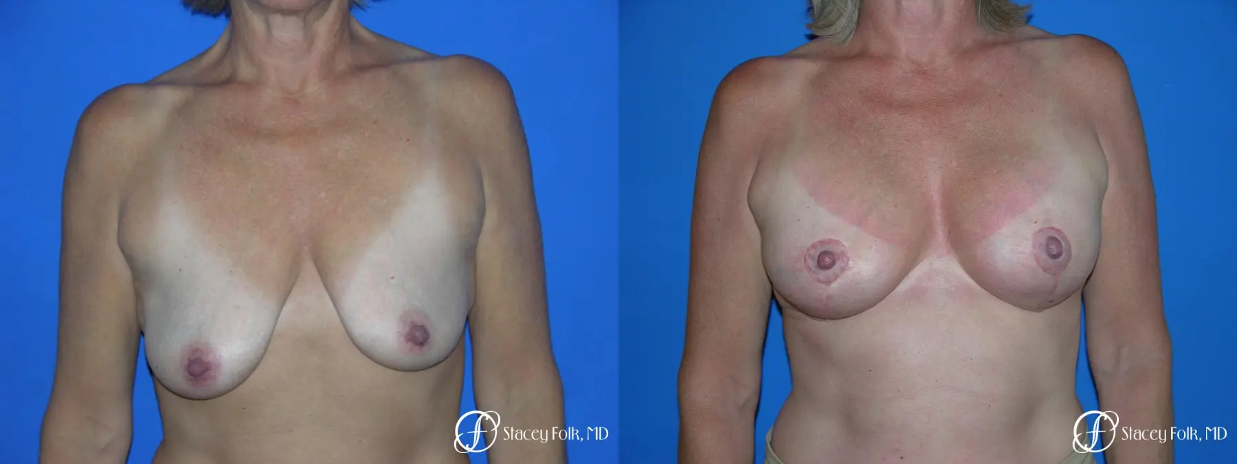 Denver Breast Lift and Augmentation 4557 - Before and After