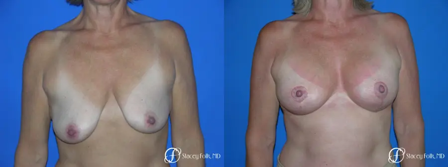 Denver Breast Lift and Augmentation 4557 - Before and After 1