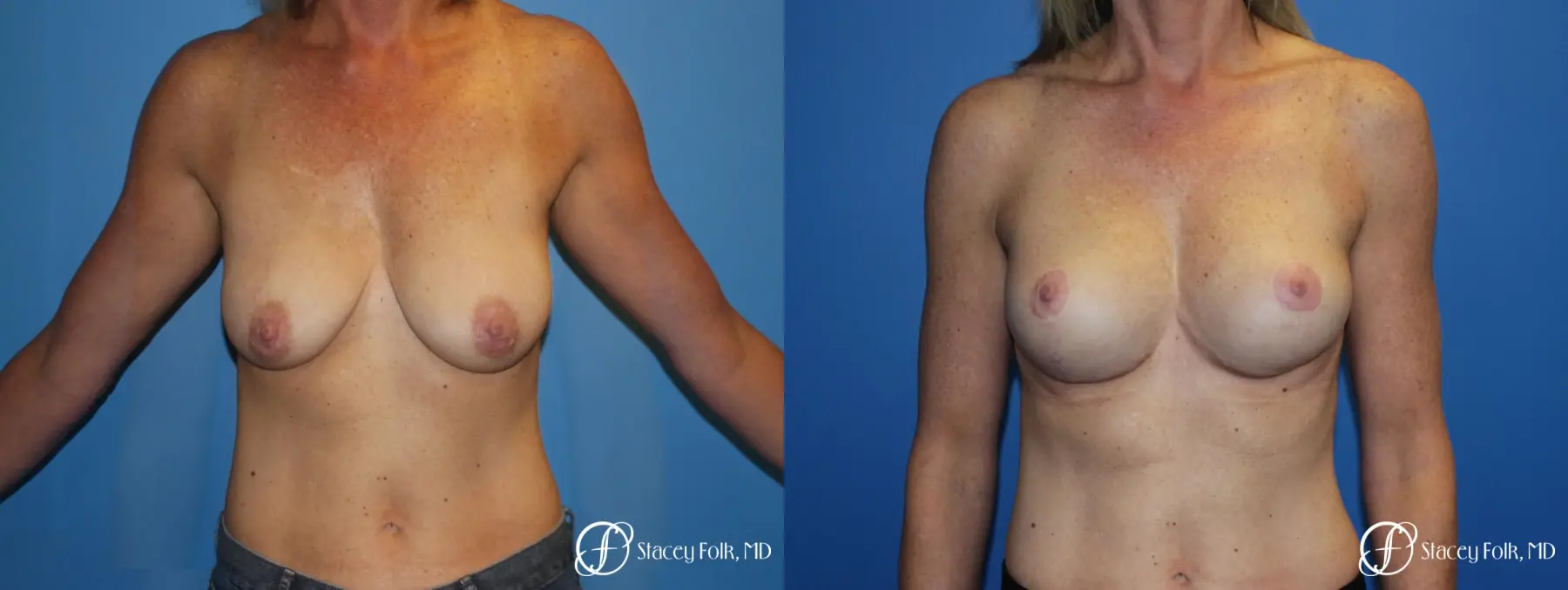 Breast Augmentation with Breast Lift (Augmentation/Mastopexy) - Before and After 1