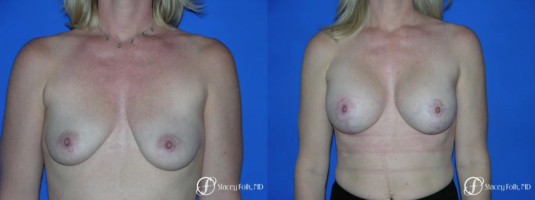 Denver Breast Lift and Augmentation 4555 - Before and After 1
